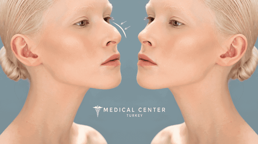 13 Rhinoplasty Recovery Tips You Need To Know