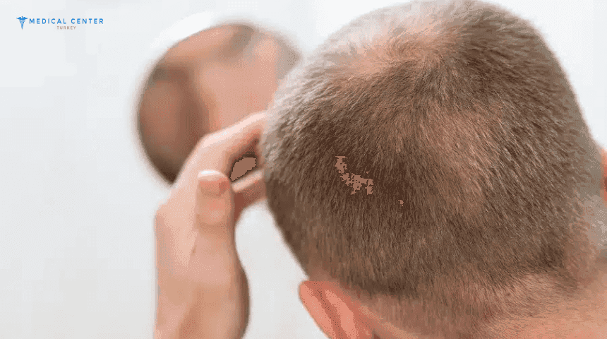 5 Things to Think About Before Getting a Hair Transplant