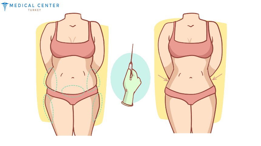 A Complete Guide to Liposuction for Women