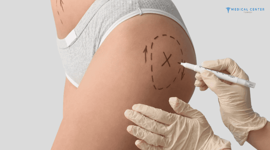 A Guide To Butt Implants In Turkey