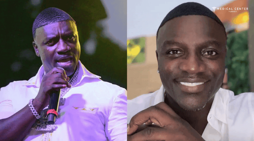 Akon's Hair Transplantation