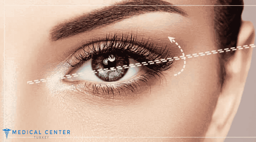 Almond Eyes Surgery