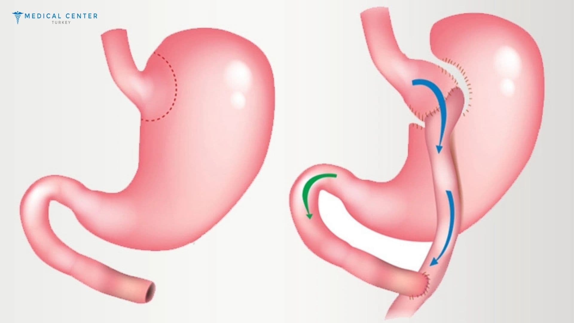 Are You Eligible for Gastric Bypass Surgery in Turkey?