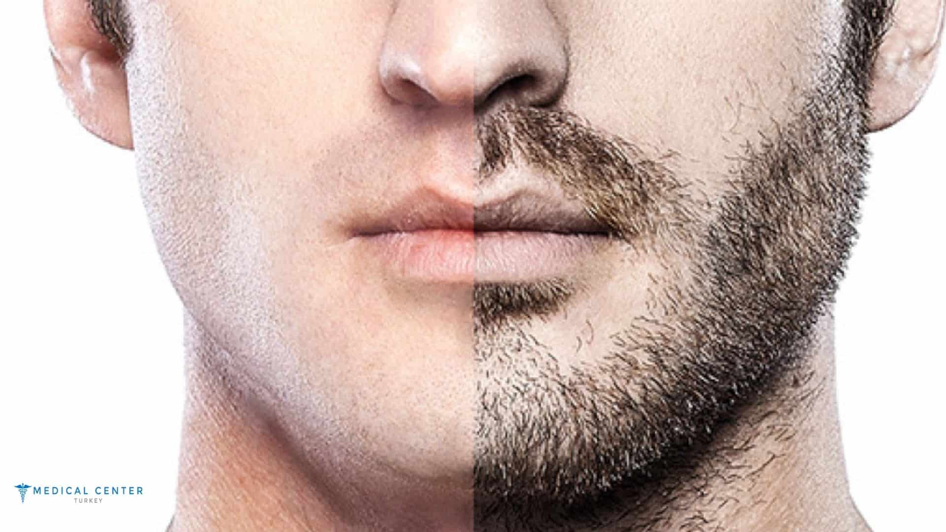 Beard Transplant Cost Turkey