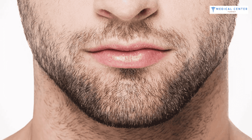 Beard Transplant In Turkey