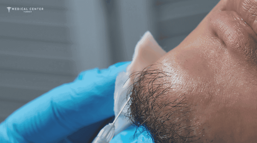 Beard Transplant in Turkey: Lower Cost, Top Care