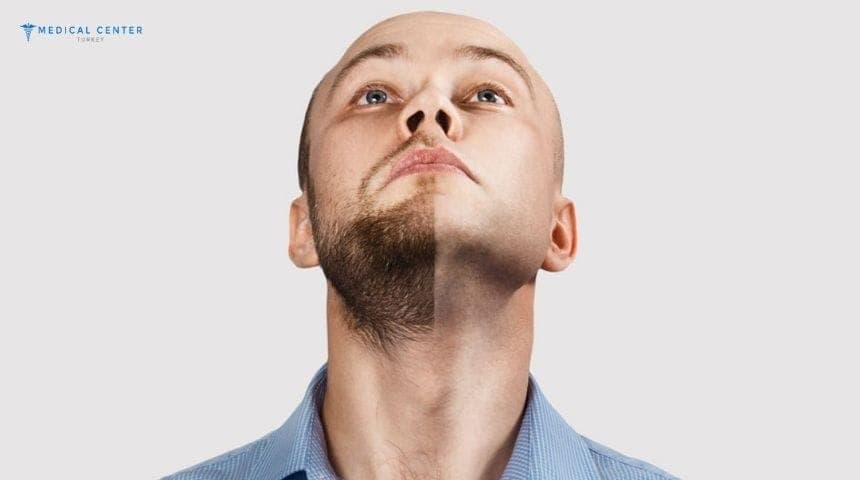 Beard Transplants Are Booming in Turkey
