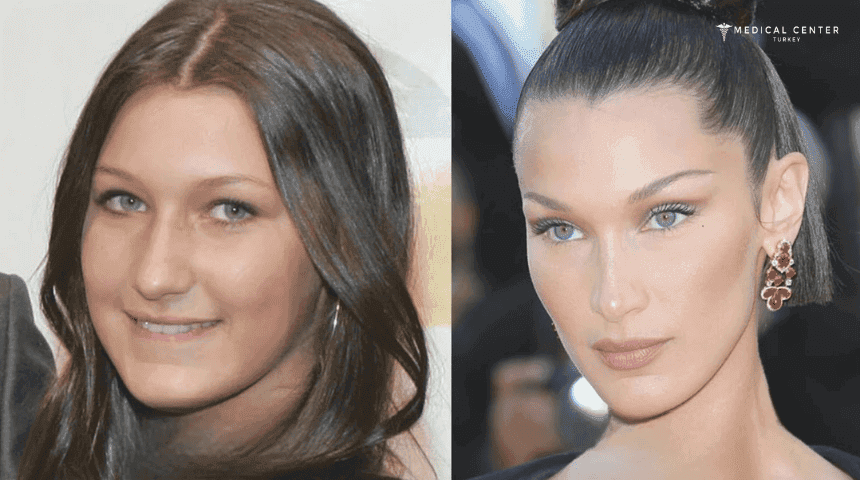 Bella Hadid's Rhinoplasty Surgery