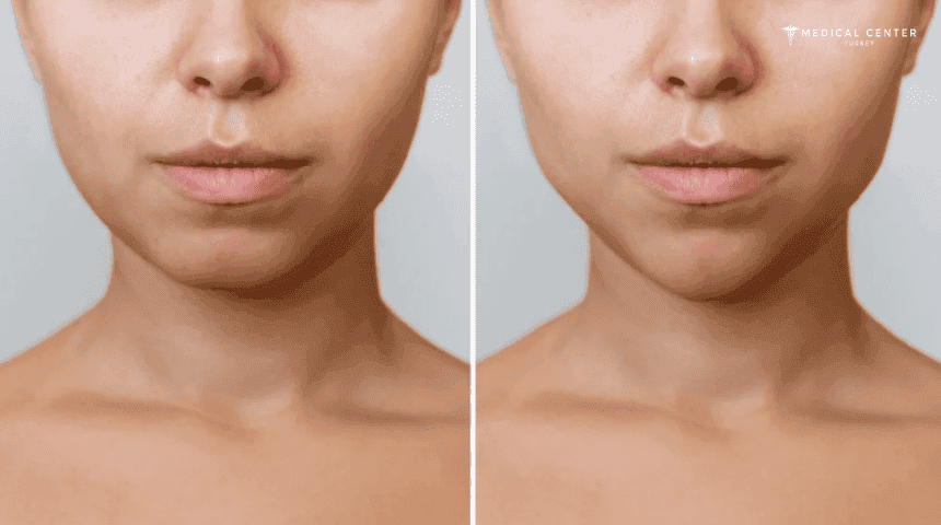 Bichectomy Surgery in Turkey