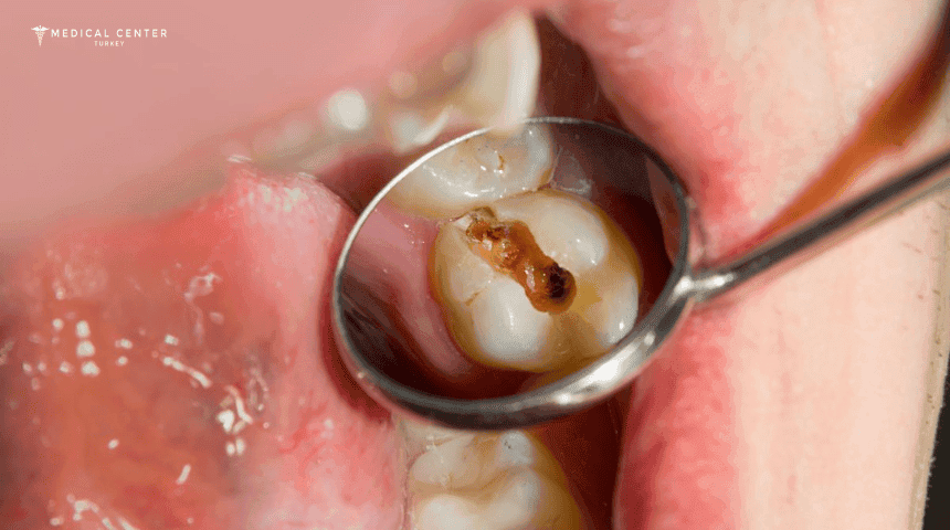 Black Teeth: Causes & Treatments in Turkey
