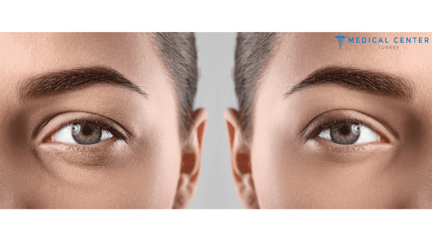 Blepharoplasty in Turkey