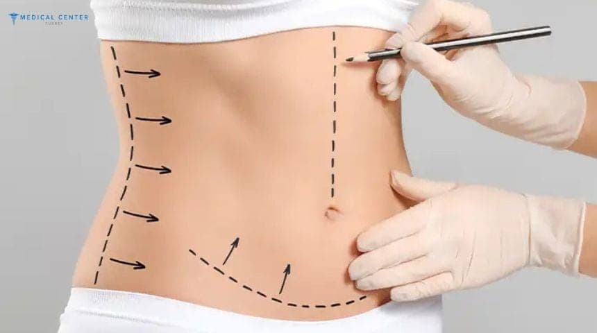 Body Mass Index (BMI) for Liposuction