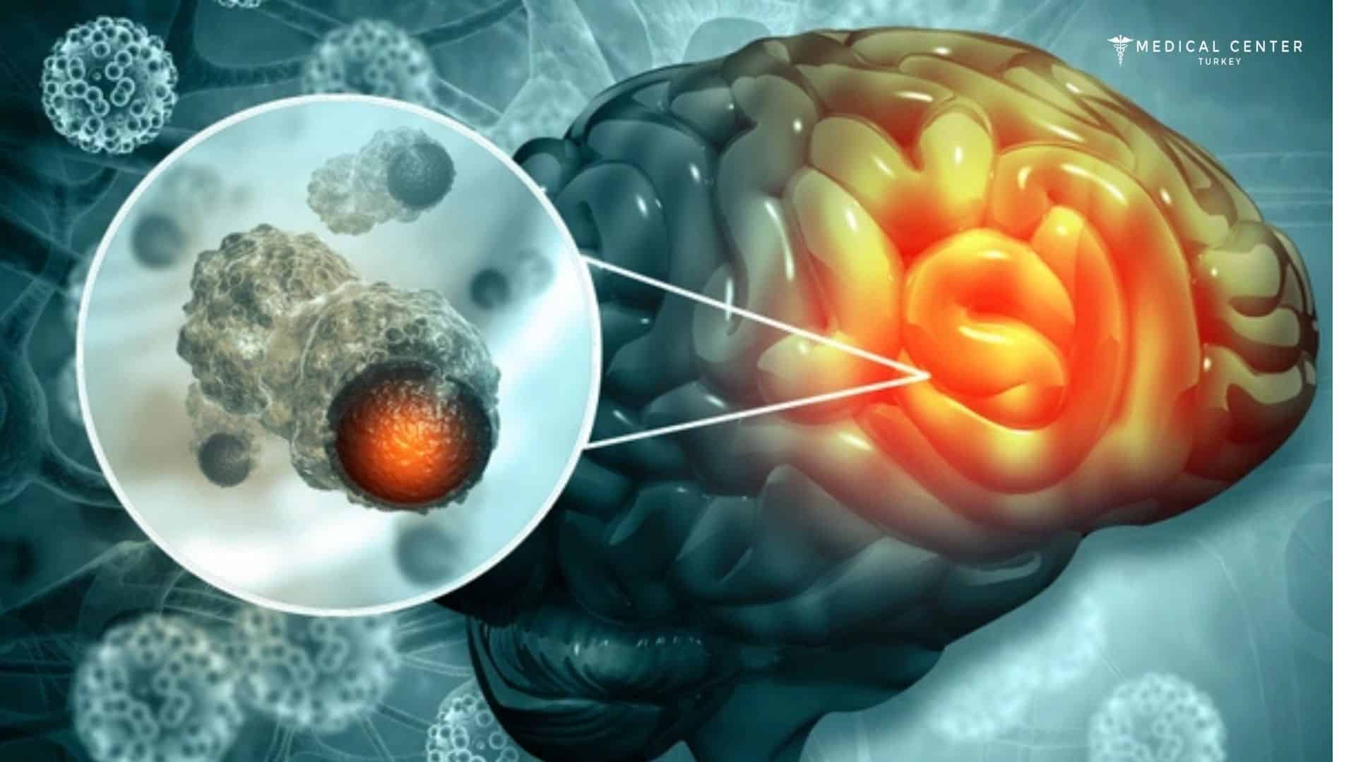 Brain Cancer Treatment in Turkey