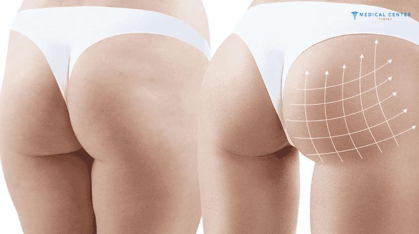 Brazilian Butt Lift in Turkey