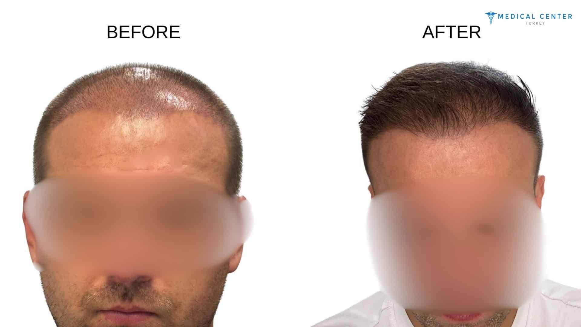 Canit’s Hair Transplant Experience in Turkey