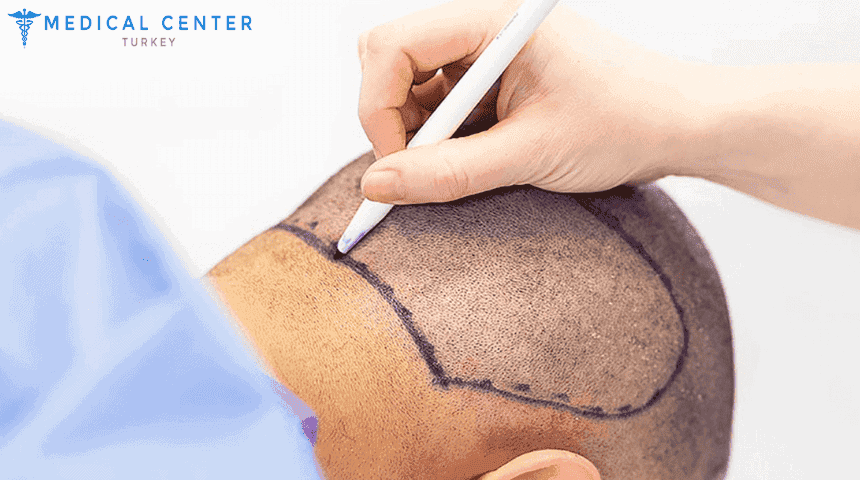 Cheapest Countries For Hair Transplant