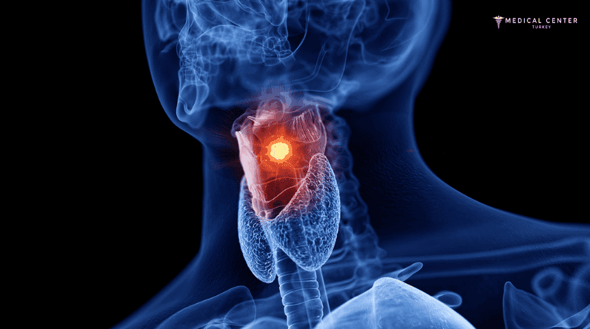 Chemotherapy for Larynx Cancer
