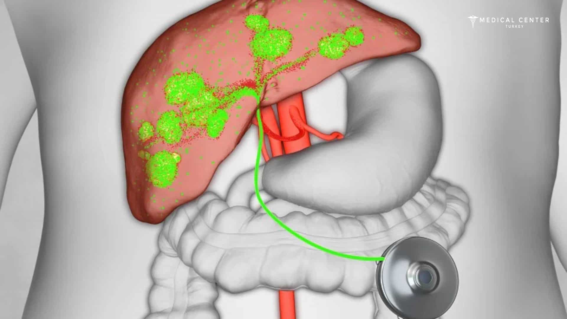 Chemotherapy for Liver Cancer