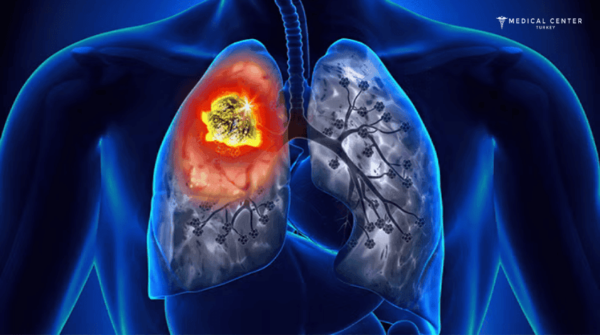 Chemotherapy For Lung Cancer