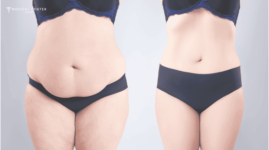 Choosing Between a Tummy Tuck and a Mini Tuck