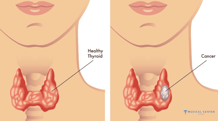 Complex Treatment for Thyroid Cancer