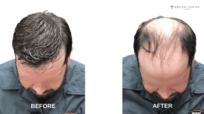 Daniel's Hair Transplant Experience in Turkey