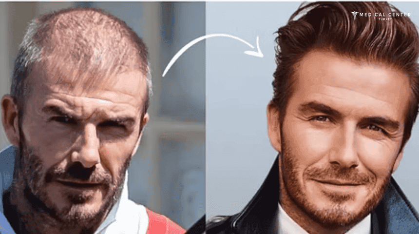 David Beckham's Hair Transplantation
