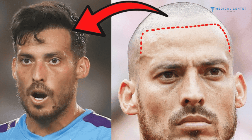 David Silva's Hair Transplantation