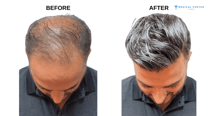 David’s Hair Transplant Experiences in Turkey