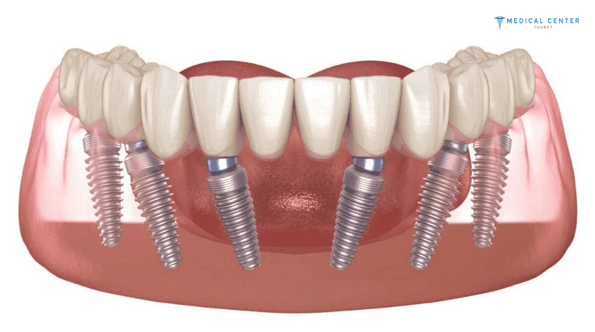 Dental Implants Cheapest Country