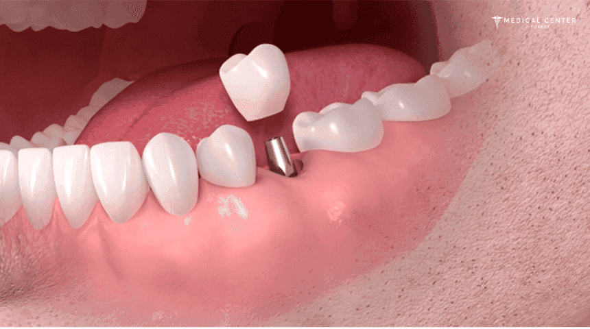 Dental Implants in Turkey: Types, Prices, Procedures