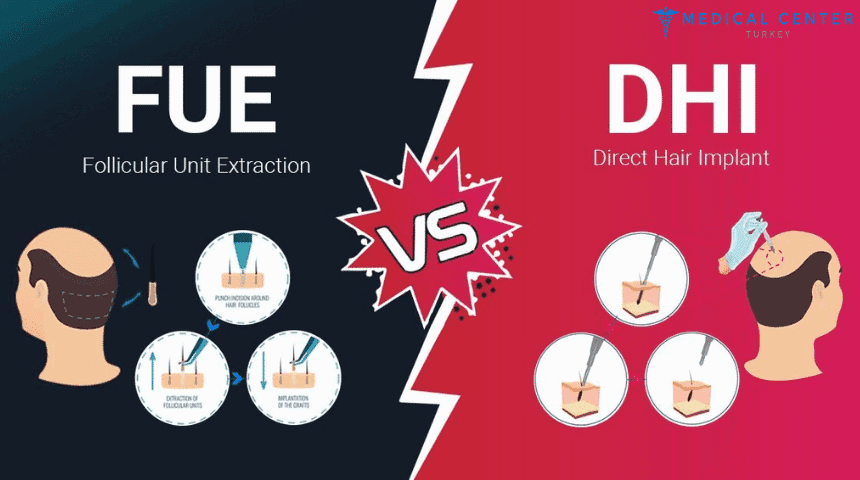 DHI vs. FUE: Hair Transplant Procedures