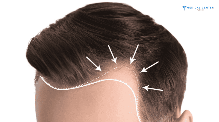 Does Finasteride Regrow Hair?