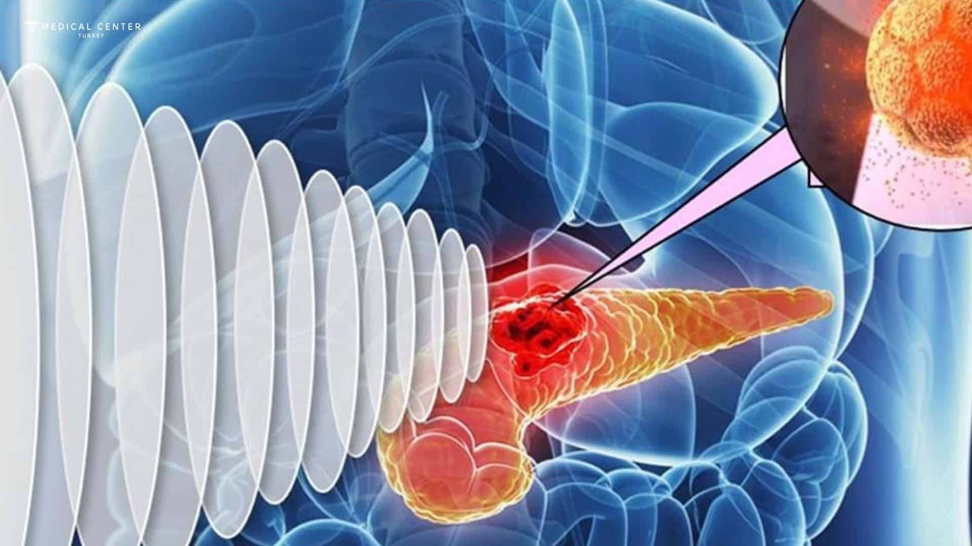 Early Cancer Detection in Turkey?