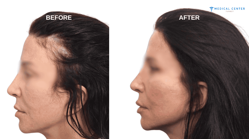 Emma's Hair Transplant Experiences in Turkey