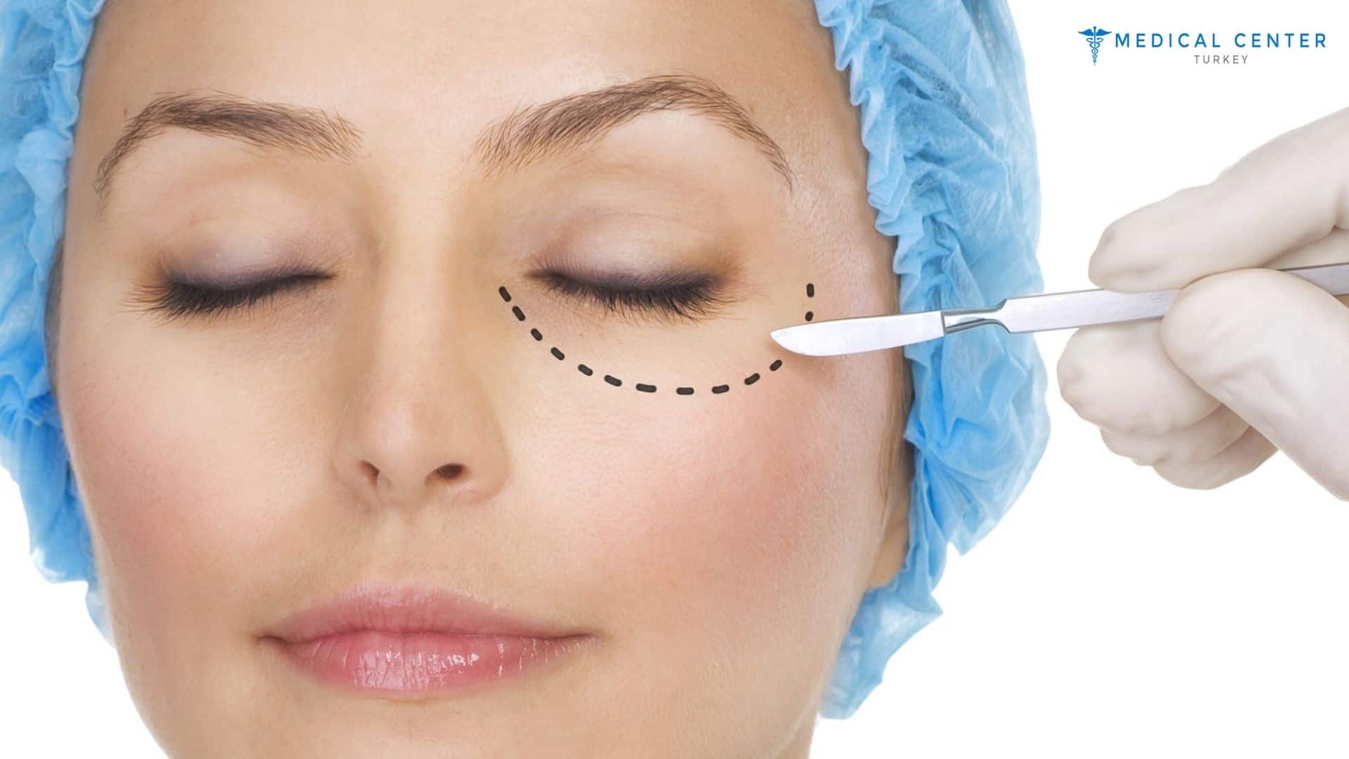 Eye Lift in Turkey: Say Goodbye to Droopy Eyelids