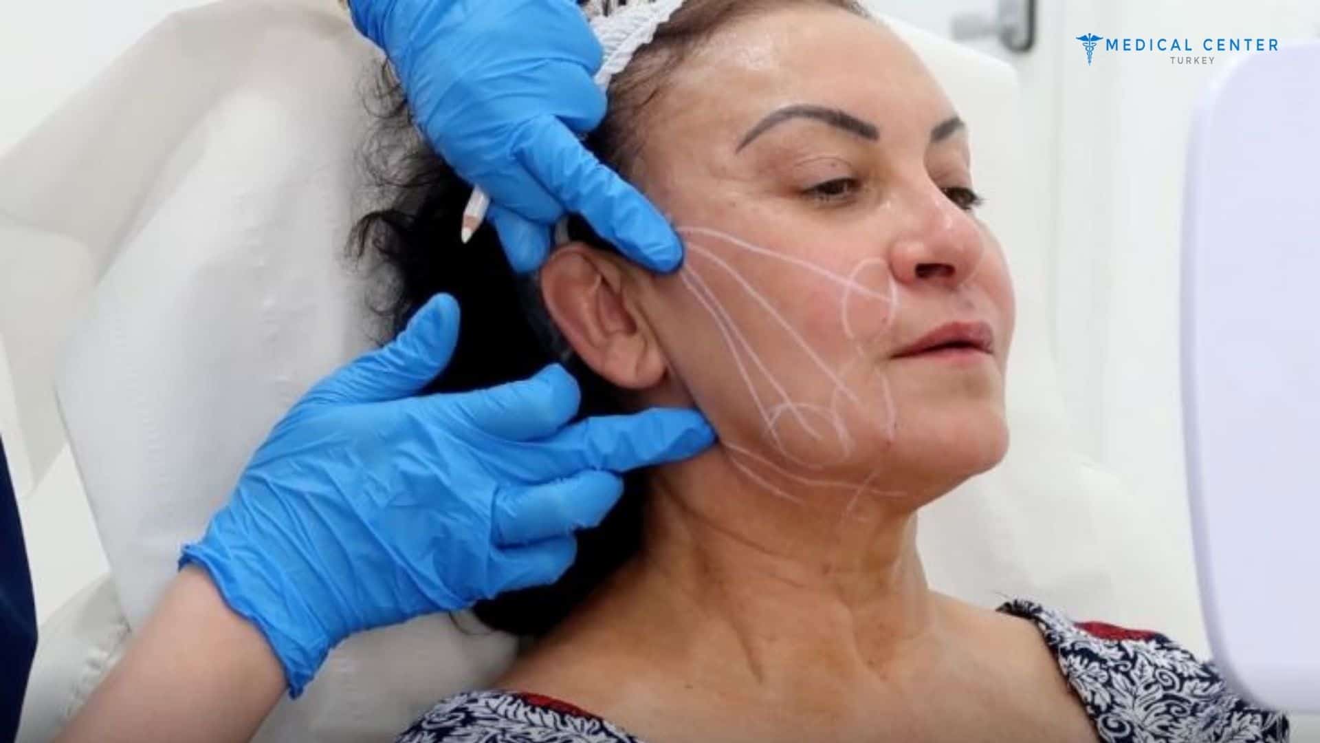 Facelift Cost in Turkey