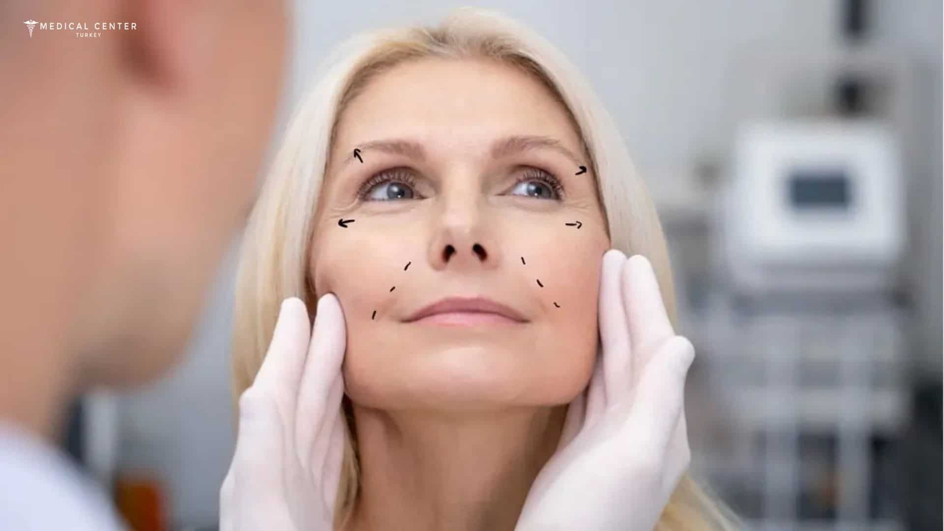 Facelift Healing Time