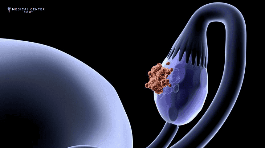 Fallopian Tube Cancer