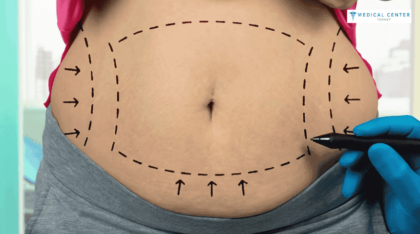 Fat Removal in Turkey