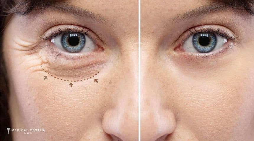 Frequently Asked Questions About Blepharoplasty