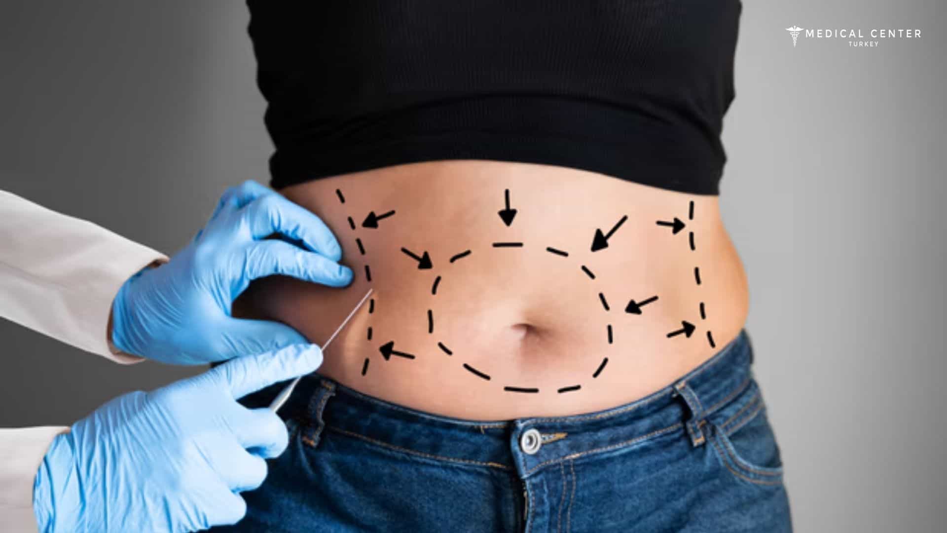 Frequently Asked Questions About Liposuction
