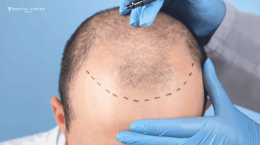 FUE Hair Transplant in Turkey