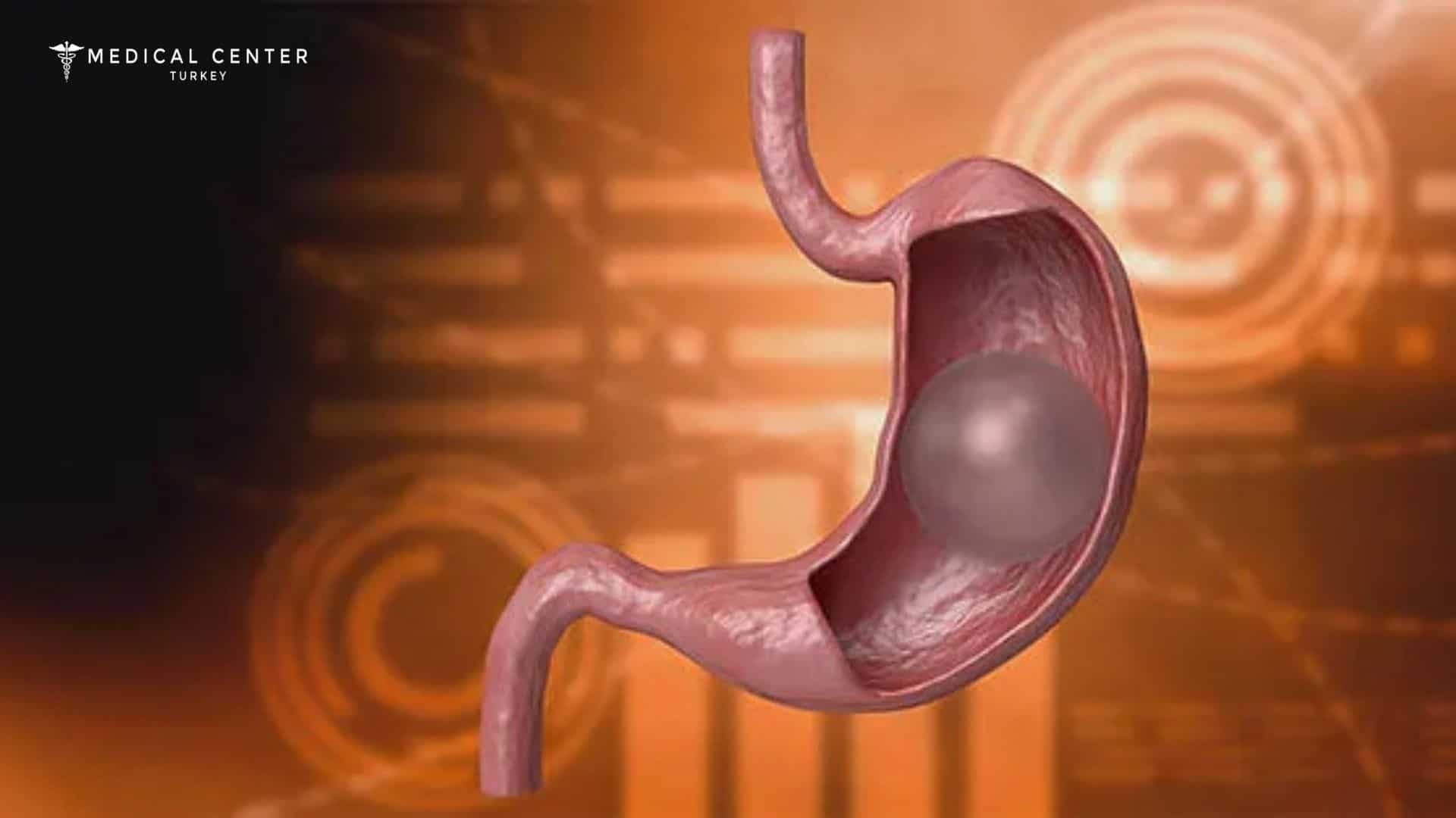 Gastric Balloon in Istanbul:Time to Heal