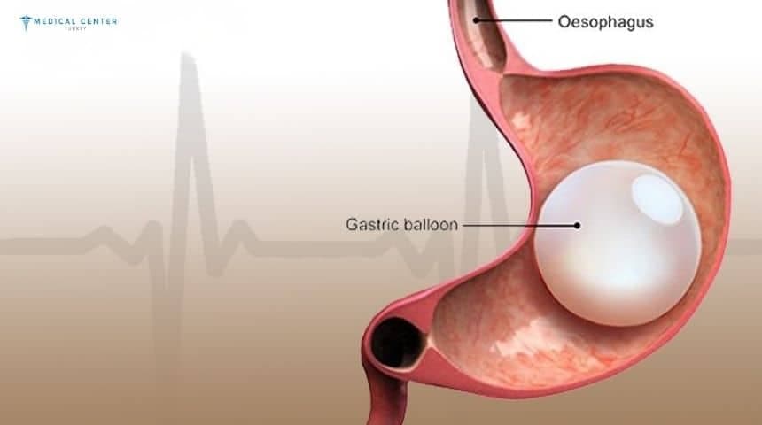 Gastric Balloon Surgery in Turkey