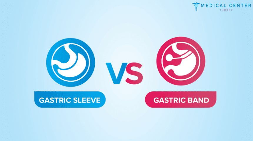 Gastric Band Vs Gastric Sleeve