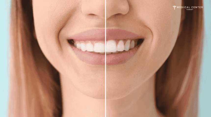 Gum Surgery in Turkey