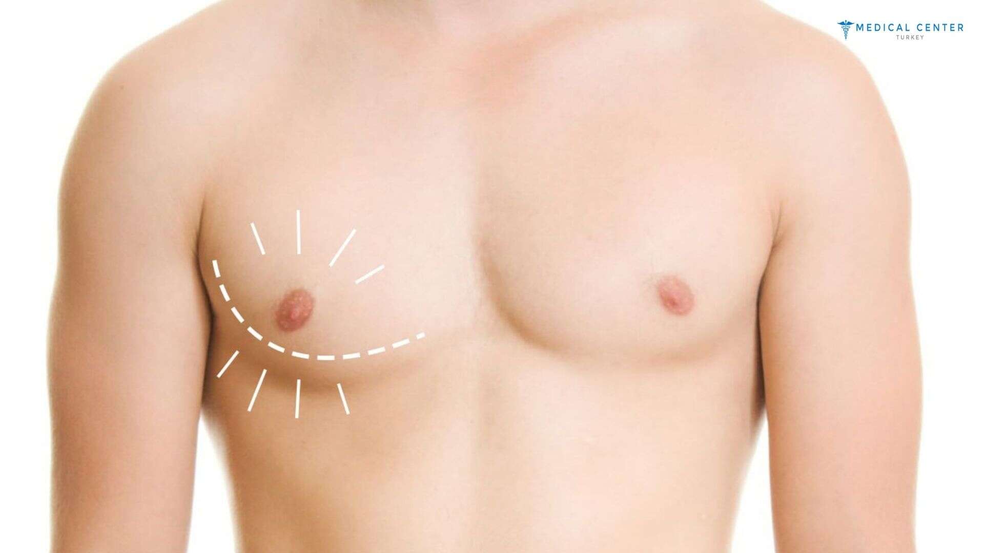 Gynecomastia in Turkey at a Glance