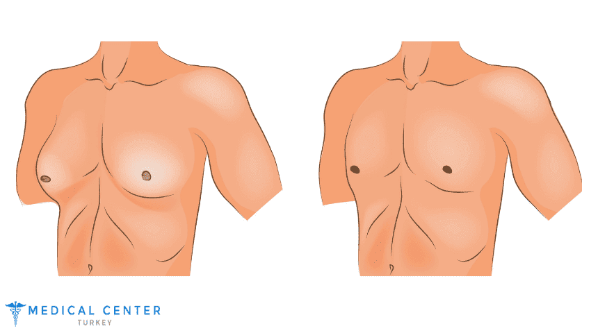 Gynecomastia Pinch Test
