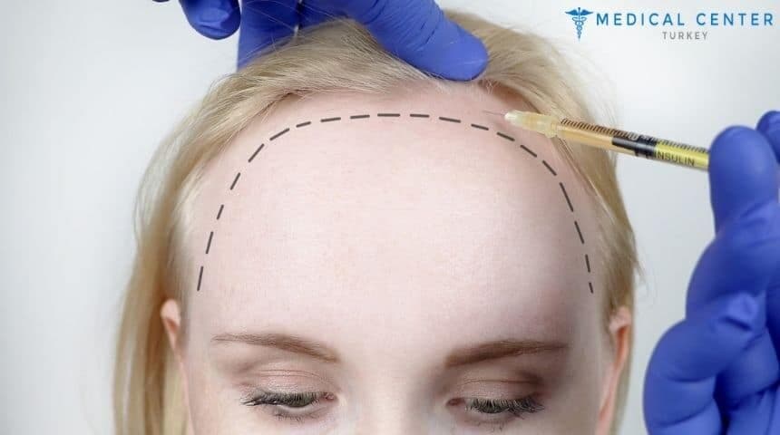 Hair Transplant for Women in Turkey